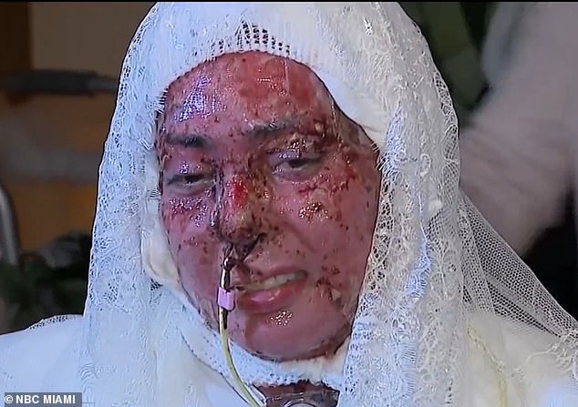 Love Defying Odds: Burned Woman Weds Fiancé in Hospital Chapel After Grill Explosion