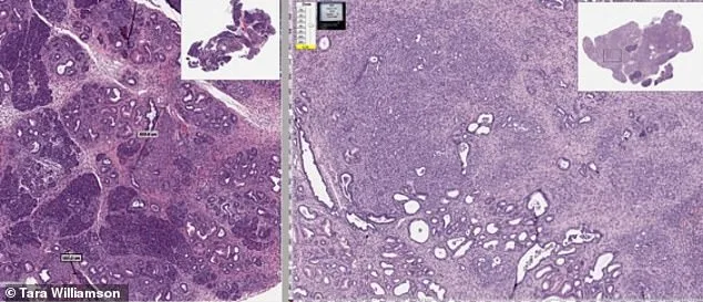 U.S. Patent Uncovers Breakthrough Cancer Treatment with Mebendazole Polymorph C
