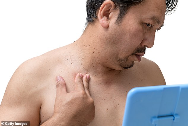 Skin Tags May Signal Undiagnosed Insulin Resistance and Diabetes Risk