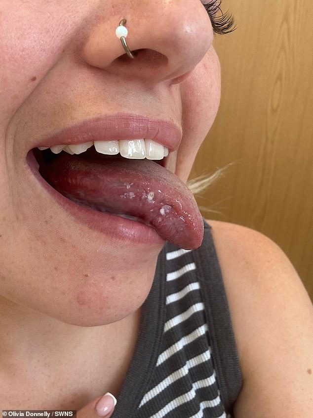 Woman's Mystery Tongue Ulcers Diagnosed as Rare Oral Cancer