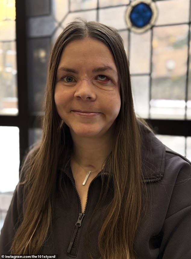 Kenai mother reveals severe injuries one year after bear attack