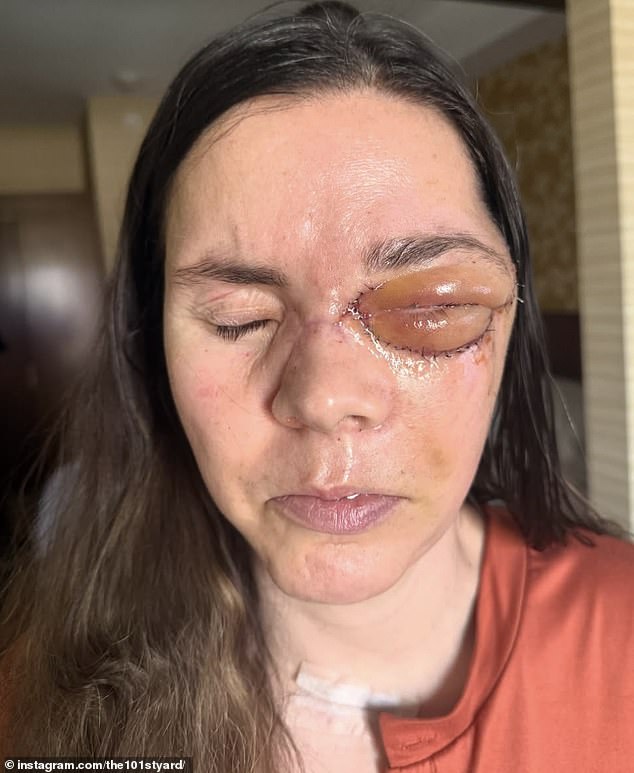 Kenai mother reveals severe injuries one year after bear attack