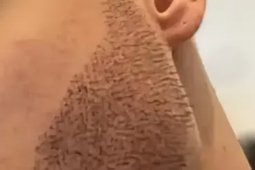 The Hidden Costs of Cheap Hair Transplants: A Surgeon Exposes Turkey's 'Conveyor Belt' Clinics