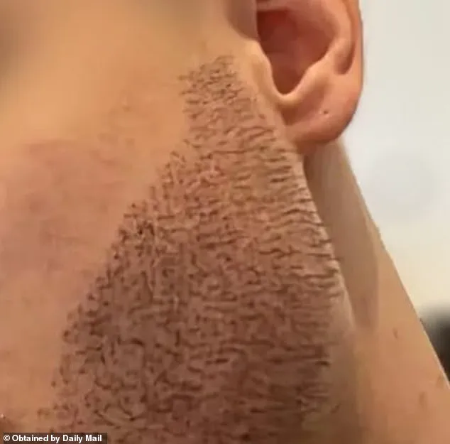 The Hidden Costs of Cheap Hair Transplants: A Surgeon Exposes Turkey's 'Conveyor Belt' Clinics